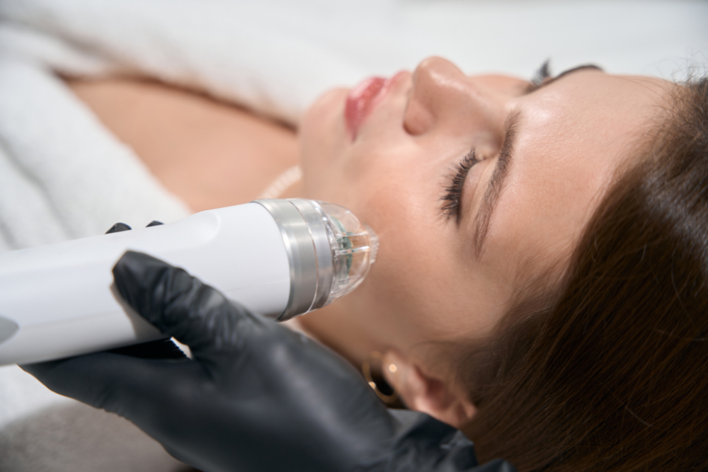 RF Microneedling Near Vienna VA