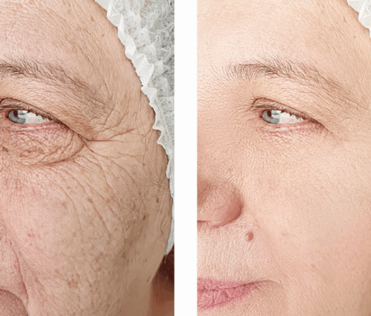 Best Laser Treatments for Skin Tightening in McLean VA