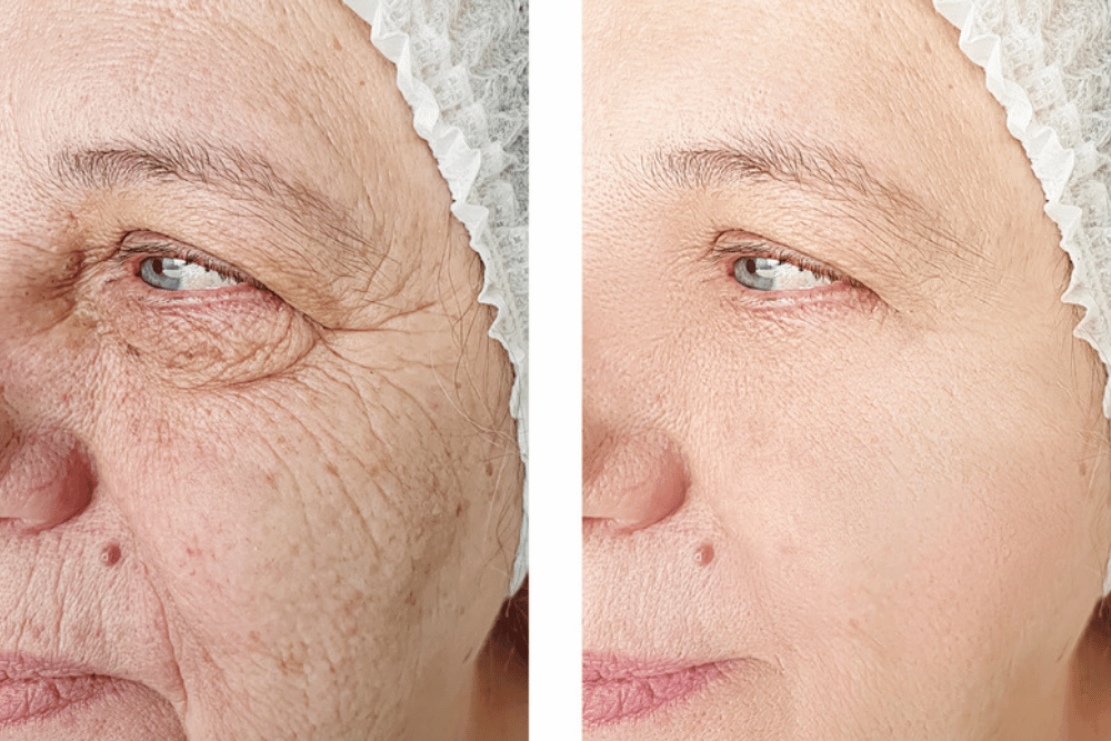 Best Laser Treatments for Skin Tightening in McLean VA