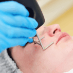 Laser Skin Tightening Near Fairfax VA