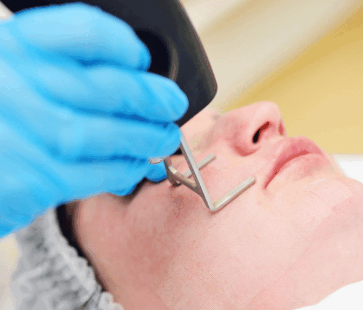 Laser Skin Tightening Near Fairfax VA
