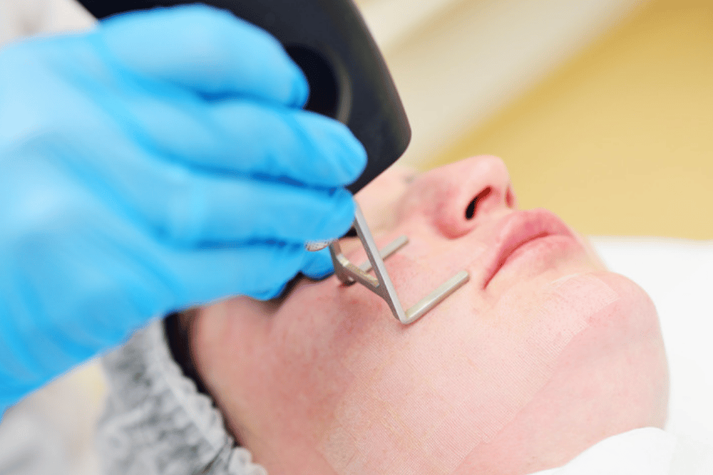 Laser Skin Tightening Near Fairfax VA