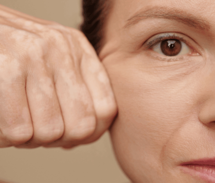 Laser Skin Tightening Pricing Near Fairfax VA